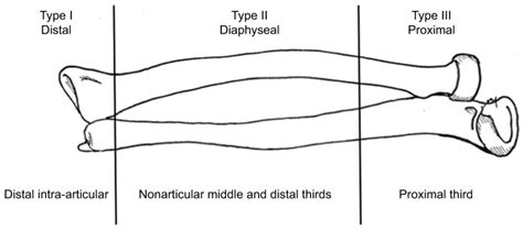 Surgical Treatment of Post-Traumatic Radio-Ulnar Synostosis