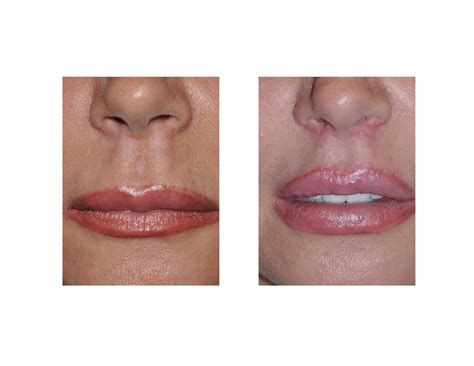 » Blog ArchiveDurability of Excisional Lip Lifts