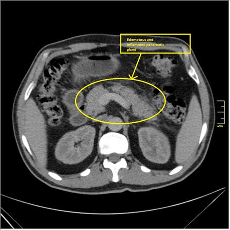Acute pancreatitis CT - wikidoc
