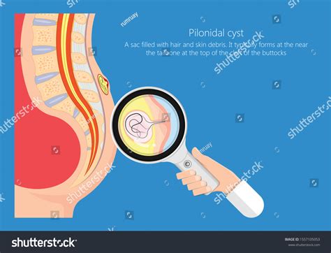 Pilonidal Cyst Nest Hair Causes Excessive Stock Vector (Royalty Free) 1557105053
