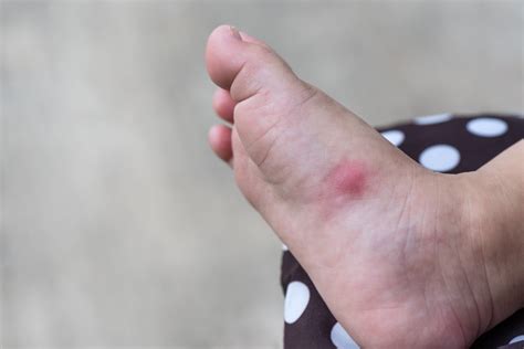 Foot rash | causes, symptoms, home remedies & treatment, pictures