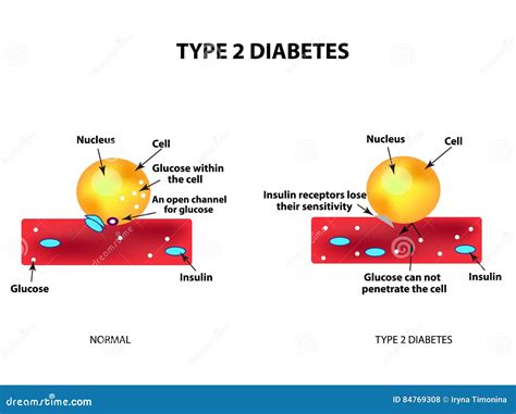 The Absorption of Glucose by the Cell. Type 2 Diabetes Stock ...