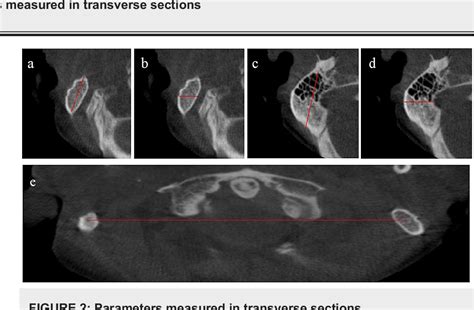 Process Bone 的图像结果