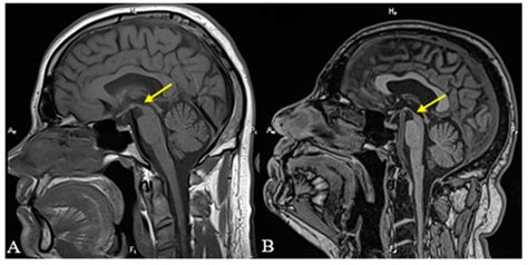 Imaging Criteria for the Diagnosis of Progressive Supranuclear Palsy ...