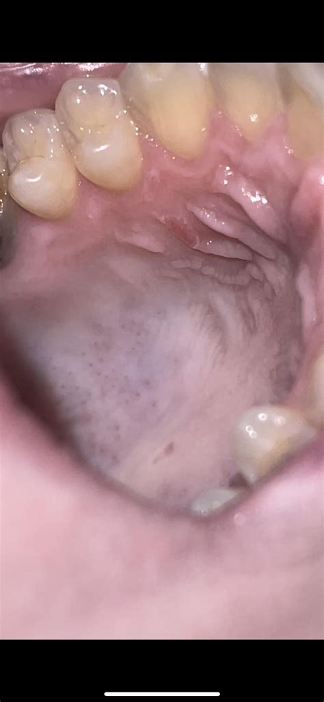 Sore roof of mouth : r/DentalHygiene