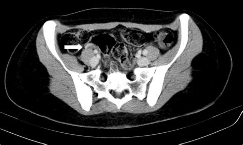Postpartum ovarian vein thrombosis and venous anatomical variation ...