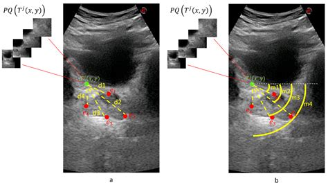 Estimation of the Prostate Volume from Abdominal Ultrasound Images by ...