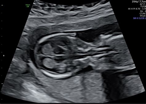 Nuchal Translucency Neck | Radiology Key