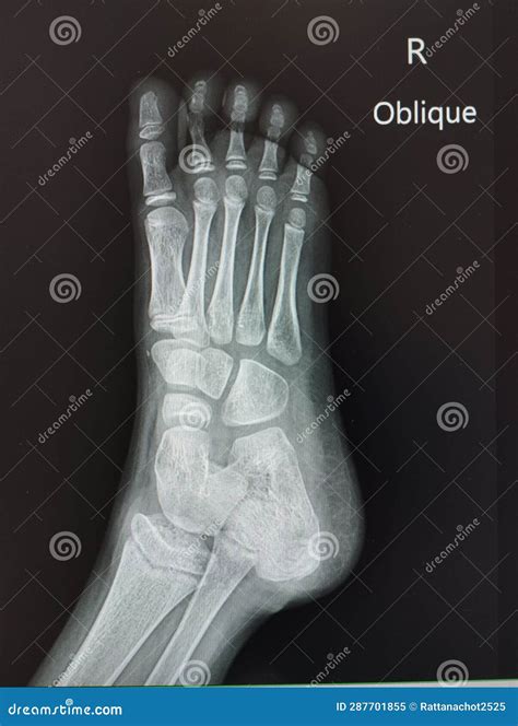 Foot Anatomy X Ray Oblique at Spencer Leschen blog
