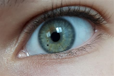 Heterocromia Iridum Azul Verde Heterochromia Iridum 🔵🟤, A