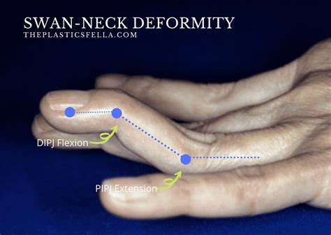 What Is Swan Neck Deformity Caused By Cheap Sale | www.opci.com