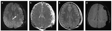 Characterization of MRI White Matter Signal Abnormalities in the Pediatric Population