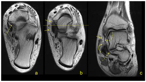 The Flexor Retinaculum Connects the Surrounding Structures into the Medial Ankle Complex