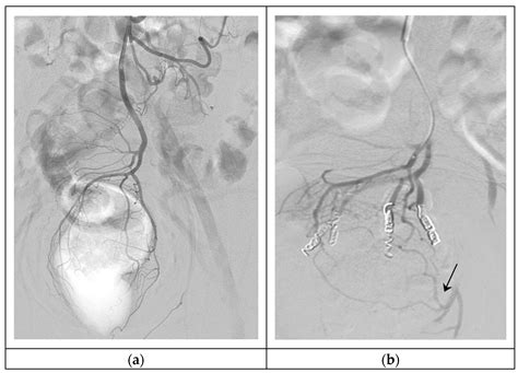 Hemorrhoid Embolization Procedure at Melba Maxwell blog