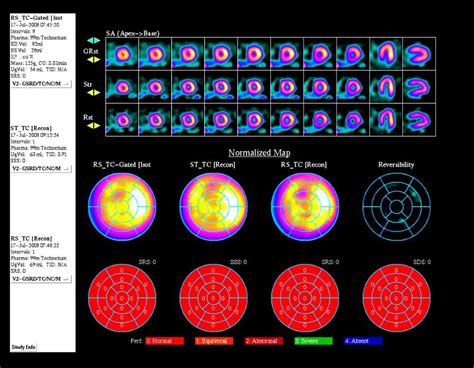 Image:Nuclear Medicine Stress Test-MSD Manual Professional Edition