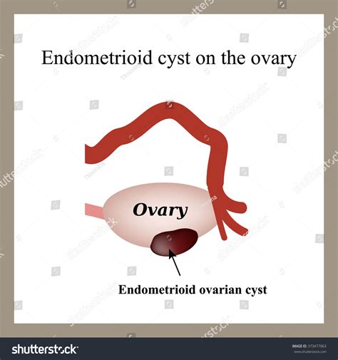 Endometrioid Cyst On Ovary Endometriosis Ovary Stock Illustration 373477963 | Shutterstock