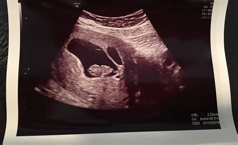 7 Week Ultrasound Twins Hiding