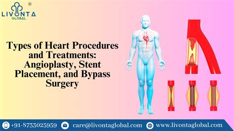 Types of Heart Procedures and Treatments: Angioplasty, Stent Placement, and Bypass Surgery ...