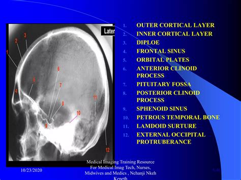 Skull x ray and pathologies radiology training resource nchanji nkeh keneth | PDF