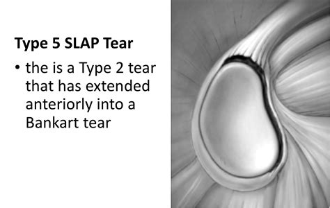 SLAP Tears – Cambridge Shoulder