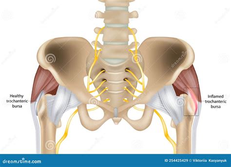 Hip Trochanteric Bursitis is Inflammation of the Bursa. Healthy and Inflamed Trochanteric Bursa ...
