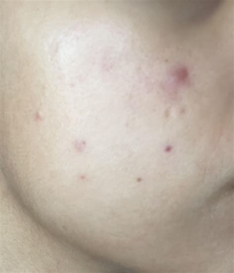 Help! Hyperpigmentation from recent hormonal breakouts. : r/SkincareAddicts