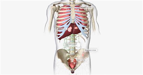 Premium Photo | The bladder cancer stage iv
