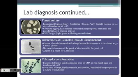 CANDIDIASIS -- Clinical Manifestations and lab diagnosis of oral ...