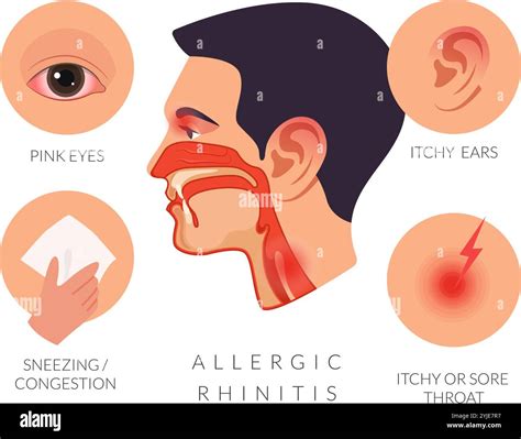 Allergic rhinitis Symptoms - Sneezing - Itchy Throat - Stock Illustration as EPS 10 File Stock ...