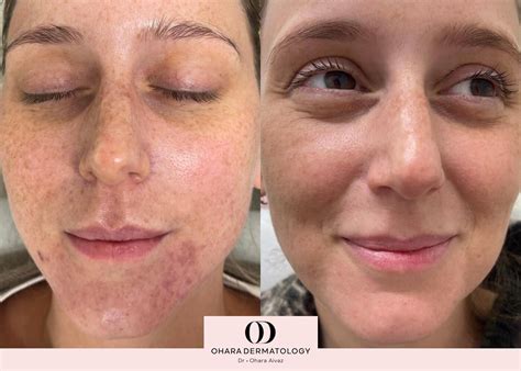 Scar Revision Procedure 的图像结果