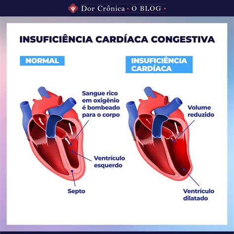Insuficiência cardíaca congestiva. Uma doença crônica que dói. - Dor ...