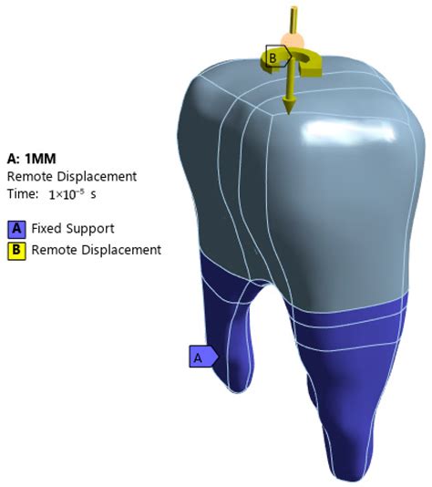 Finite Element Analysis of Dental Diamond Burs: Stress Distribution in ...