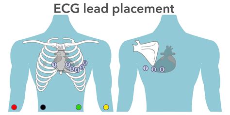 ECG placement & mis-LEADing ECG’s – EMbeds.co.uk
