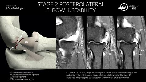 Radial Collateral Ligament Elbow