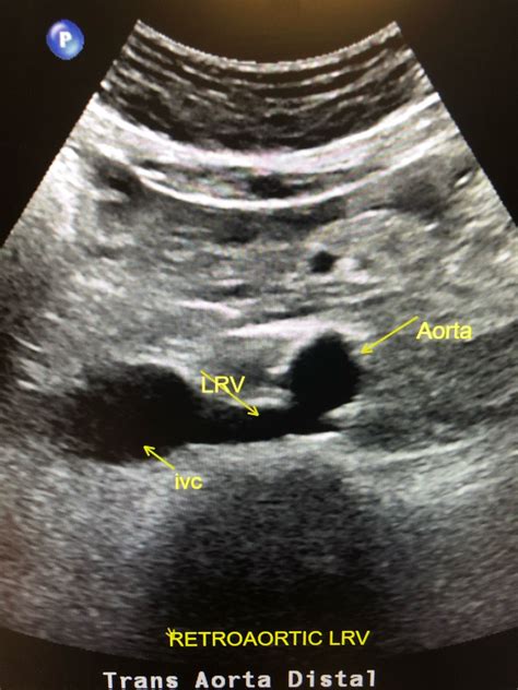 Retroaortic Left Renal Vein
