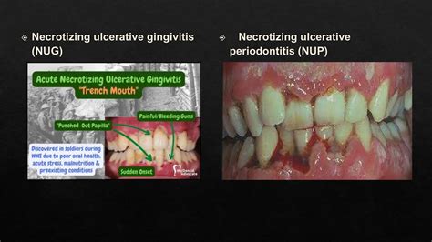 Image result for Classification Periodontitis