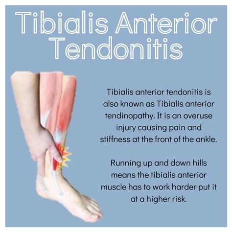 Tibialis Anterior Tendonitis