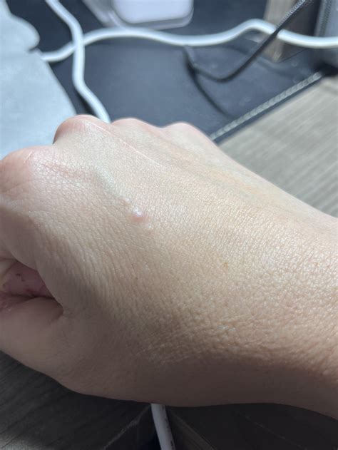 Bumps on the back of my hand : r/SkincareAddicts
