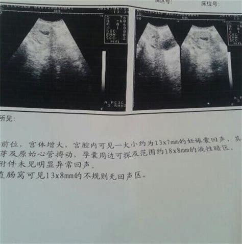 怀孕2个月胎芽有多大没有胎心的胎囊胎芽还在长_第二人生
