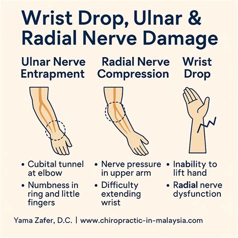 Ulnar Nerve Palsy Treatment