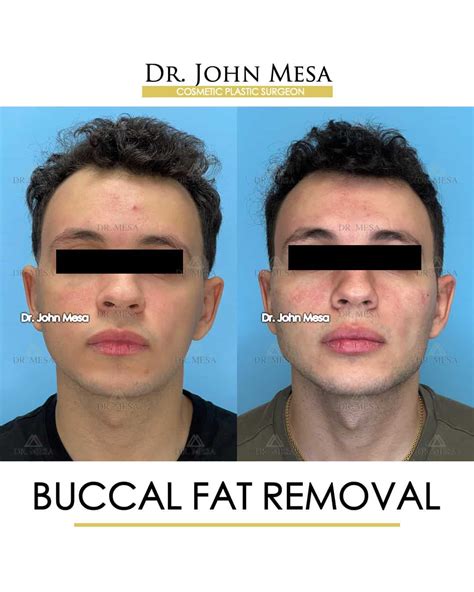 Buccal Fat Removal Before After