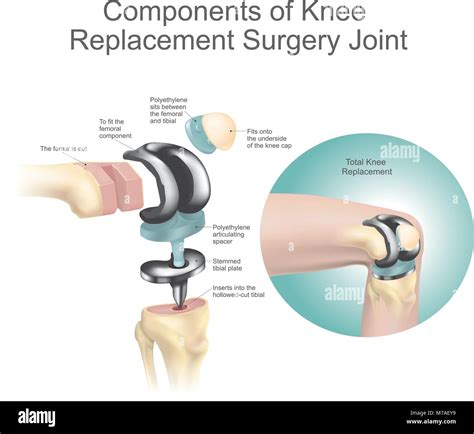Components of knee replacement surgery joint Stock Vector Image & Art - Alamy