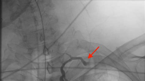 Microsurgical Lymphovenous Bypass of the Thoracic Duct | Clinical Briefing