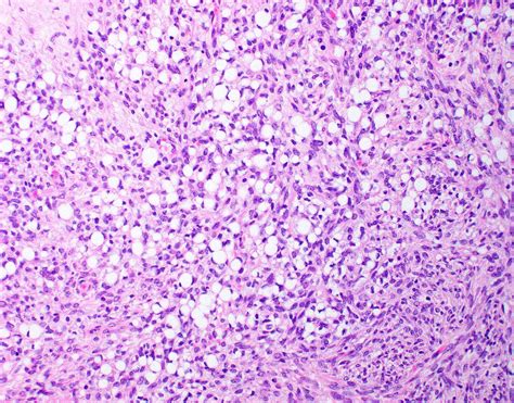 Pathology Outlines - Signet ring stromal tumor