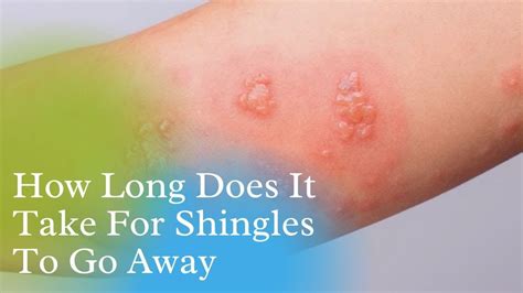 shingles treatment valacyclovir