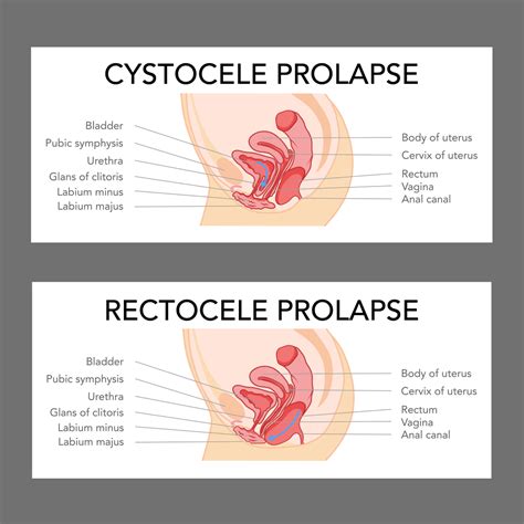 Rectocele Surgery Identifying And Treating Pelvic Organ Prolapse