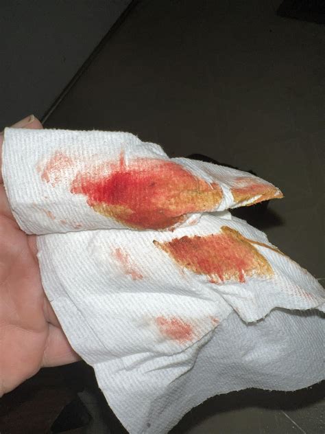 blood on toilet paper help : r/medical_advice