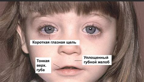 Фетальный алкогольный синдром - статья на сайте клиники Вита