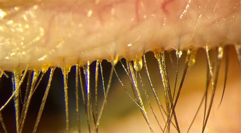 What Is Demodex And Blepharitis Lash Resource What is blepharitis ...