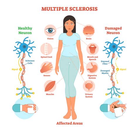 MULTIPLE SCLEROSIS FULL DETAILS - SPECIAL EDUCATION